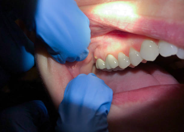 Best Emergency Denture Repair in Union City, OK