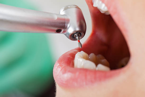 Best Emergency Root Canal Treatment in Union City, OK